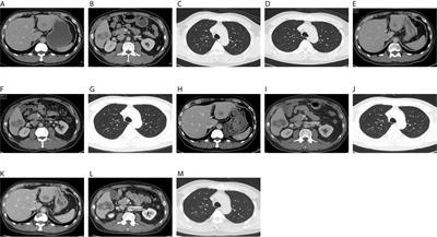 Combination of Anti-EGFR and Anti-VEGF Drugs for the Treatment of Previously Treated Metastatic Colorectal Cancer: A Case Report and Literature Review